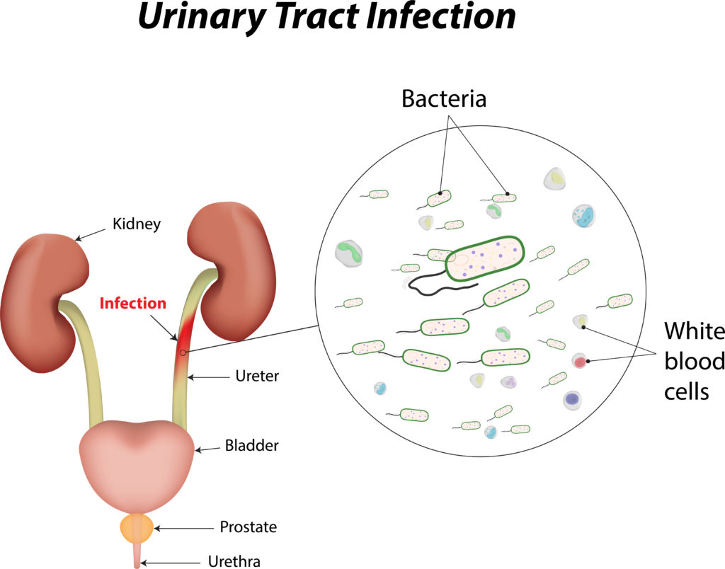 Treatment of Urine burning - Masala TV